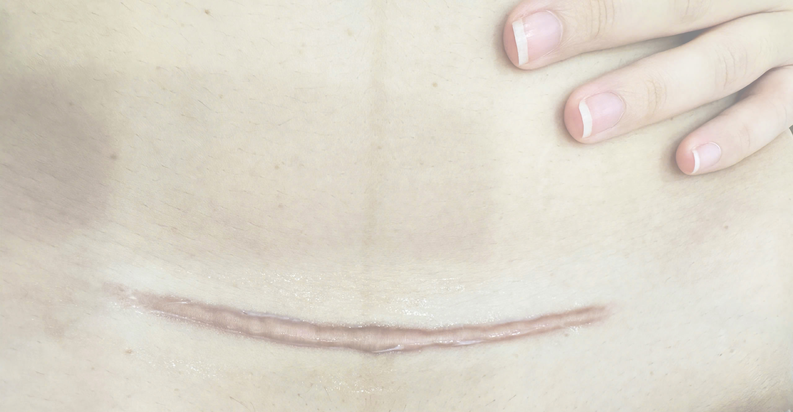 Sẹo lồi, sẹo phì đại: những điều cần biết và cách xử trí