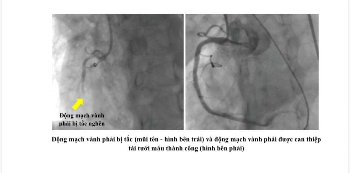 Sở Y tế TP.HCM: Kích hoạt quy trình E-CPR liên viện cứu sống bệnh nhân ngưng tim trước nhập viện