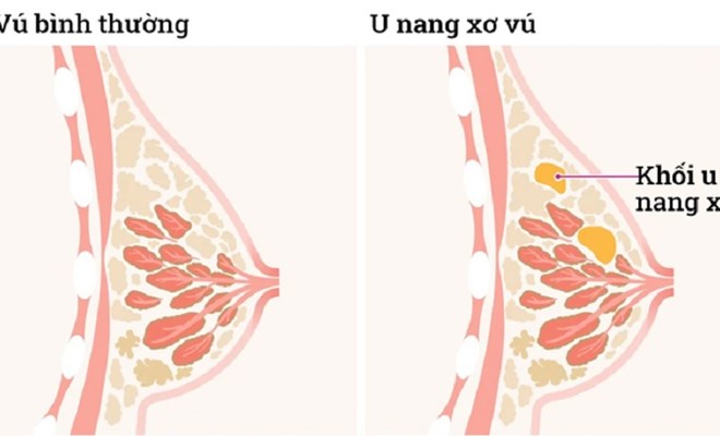 Phát hiện sớm, điều trị kịp thời các bệnh lý tuyến vú