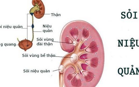 Đừng chủ quan với sỏi niệu quản