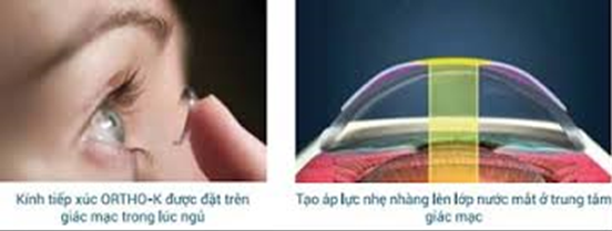 Điều trị cận thị bằng kính tiếp xúc cứng đeo đêm (Ortho-K)