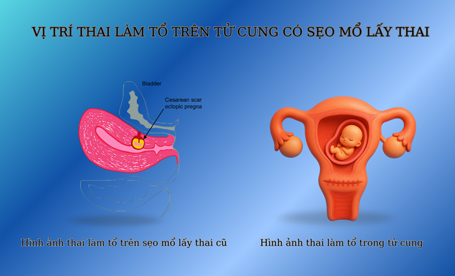 Thai bám sẹo mổ cũ là gì? (Chửa vết mổ lấy thai là gì?)