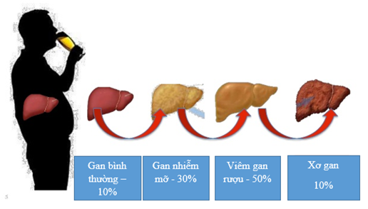 Viêm gan do rượu – chẩn đoán, điều trị và phòng ngừa