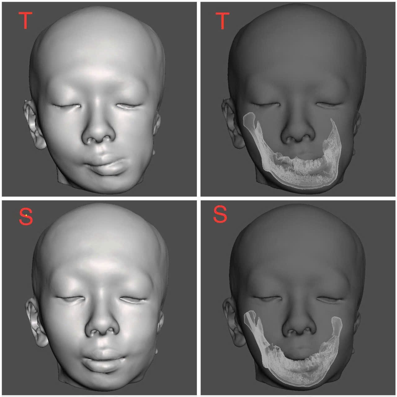 Bệnh viện Răng Hàm Mặt TP.HCM: Trả lại gương mặt cho hai phụ nữ trẻ bị dị dạng hàm mặt phức tạp