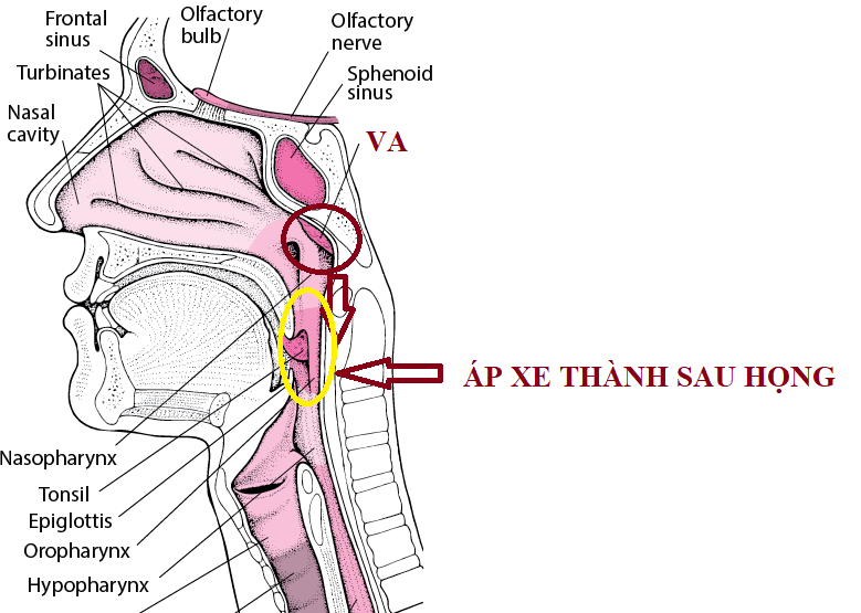 Áp xe thành sau họng – biến chứng nguy hiểm của viêm VA