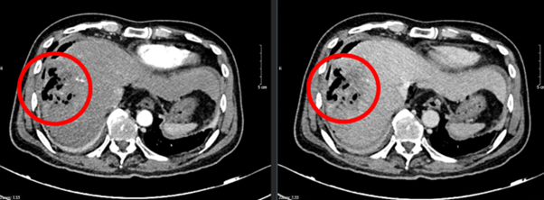 Ca lâm sàng: Điều trị ung thư biểu mô tế bào gan tại Bệnh viện Bạch Mai