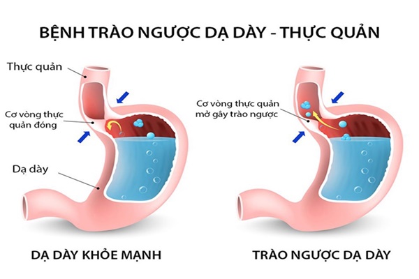 Bệnh trào ngược dạ dày – thực quản: Nguyên nhân, triệu chứng và cách điều trị hiệu quả