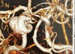 Làm chủ kỹ thuật đặt stent chuyển dòng điều trị túi phình động mạch não kích thước lớn