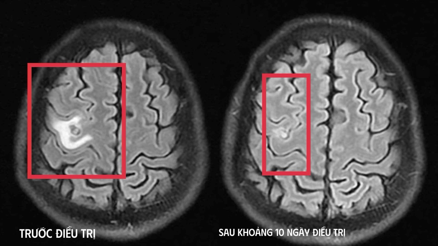 Điều trị thành công ca tổn thương não do sán