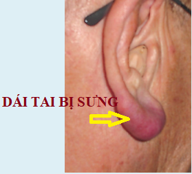 Dái tai của bạn bị sưng – xử trí thế nào?