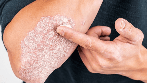 Chung sống lâu dài với bệnh vảy nến: Những điều cần biết