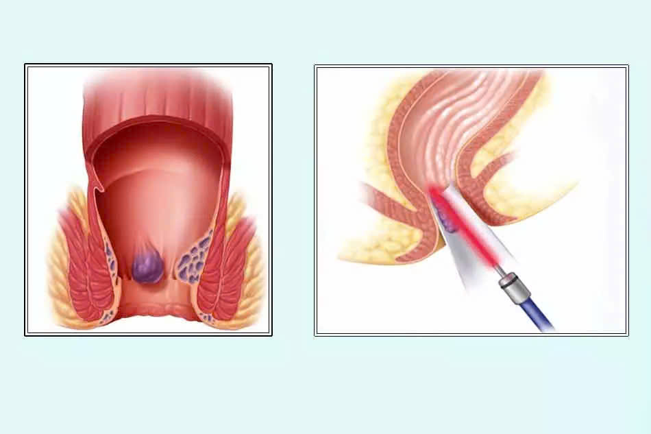 ỨNG DỤNG LASER TRONG ĐIỀU TRỊ BỆNH TRĨ: GIẢI PHÁP HIỆU QUẢ, AN TOÀN CHO NGƯỜI BỆNH