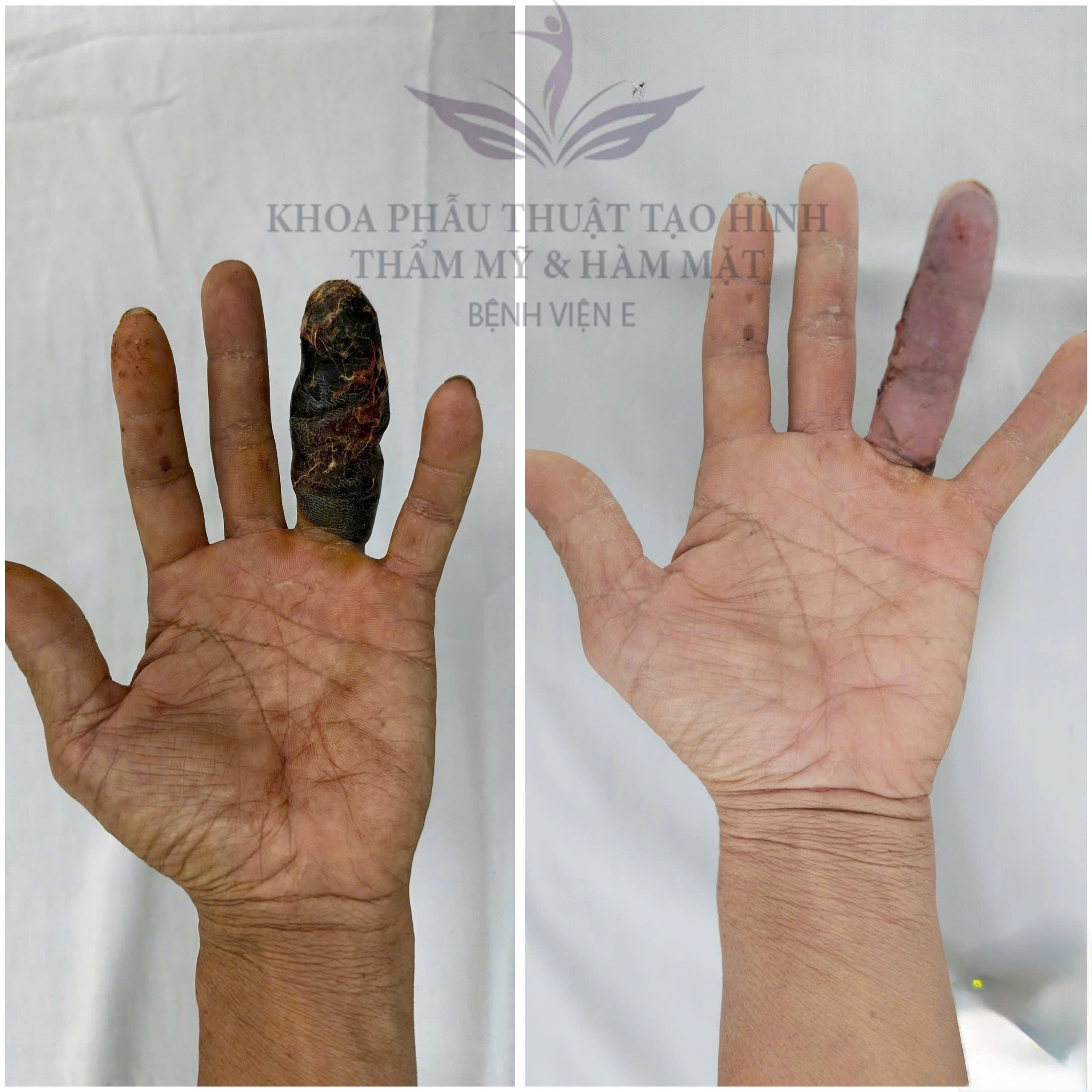 HOẠI TỬ BÀN TAY TRÊN BỆNH NHÂN LƠ XƠ MI MẠN NGUY CƠ MẤT NGÓN – XỬ TRÍ THEO MÔ HÌNH ĐA CHUYÊN KHOA