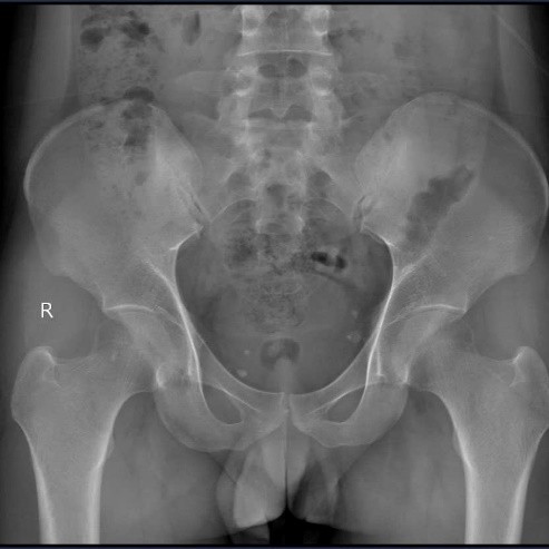 CASE LÂM SÀNG: CẢNH BÁO ĐAU CỘT SỐNG CỔ Ở NGƯỜI TRẺ – ĐỪNG CHỦ QUAN VỚI BỆNH VIÊM CỘT SỐNG DÍNH KHỚP