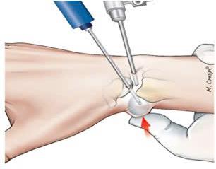 PHẪU THUẬT NỘI SOI KHỚP CỔ TAY: HƯỚNG TIẾP CẬN ÍT XÂM LẤN TRONG ĐIỀU TRỊ VIÊM KHỚP PHỨC TẠP