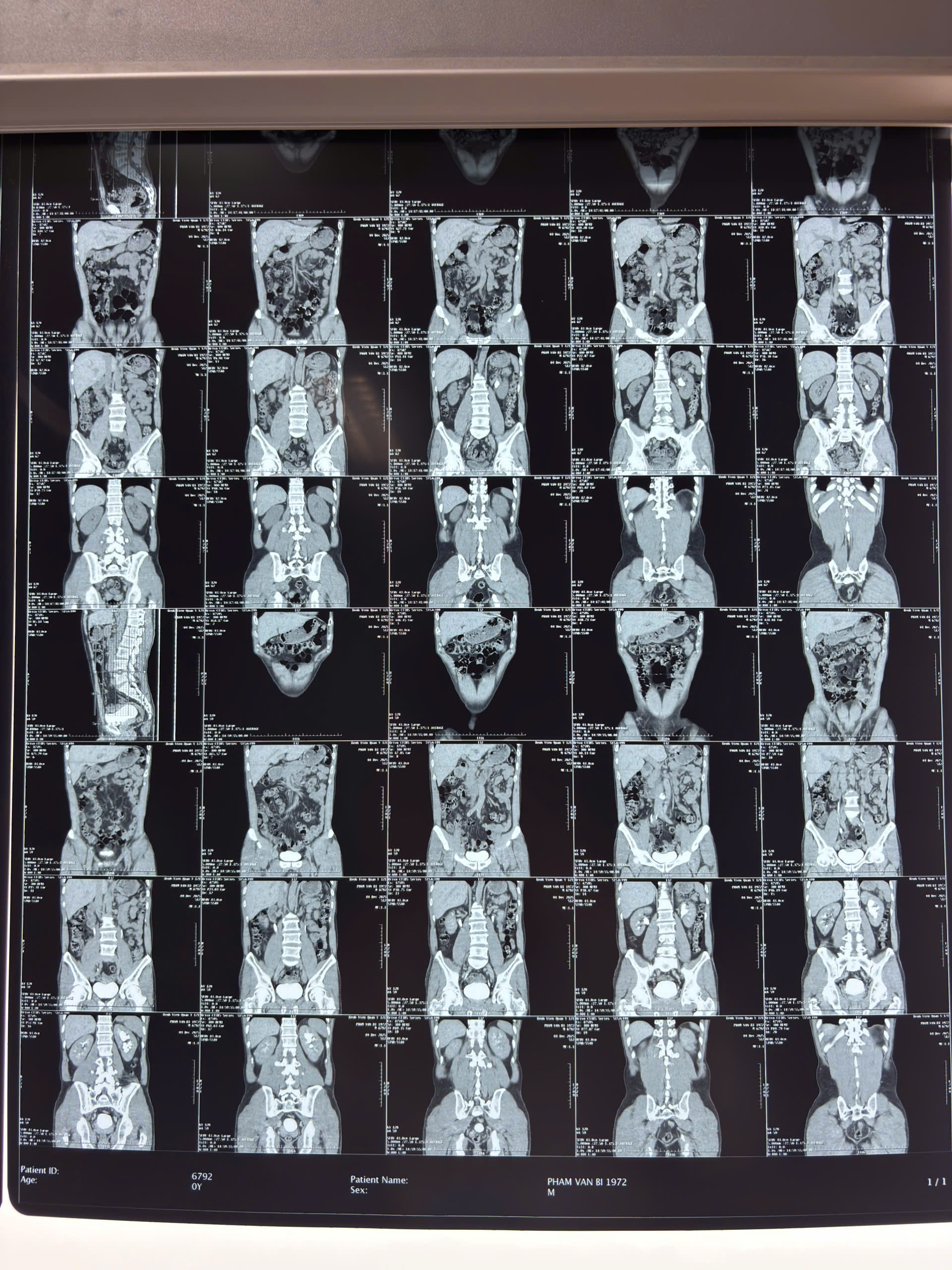 PHÁT TRIỂN KỸ THUẬT TÁN SỎI ÍT XÂM LẤN, KHÔNG ĐAU, NÂNG CAO HIỆU QUẢ ĐIỀU TRỊ