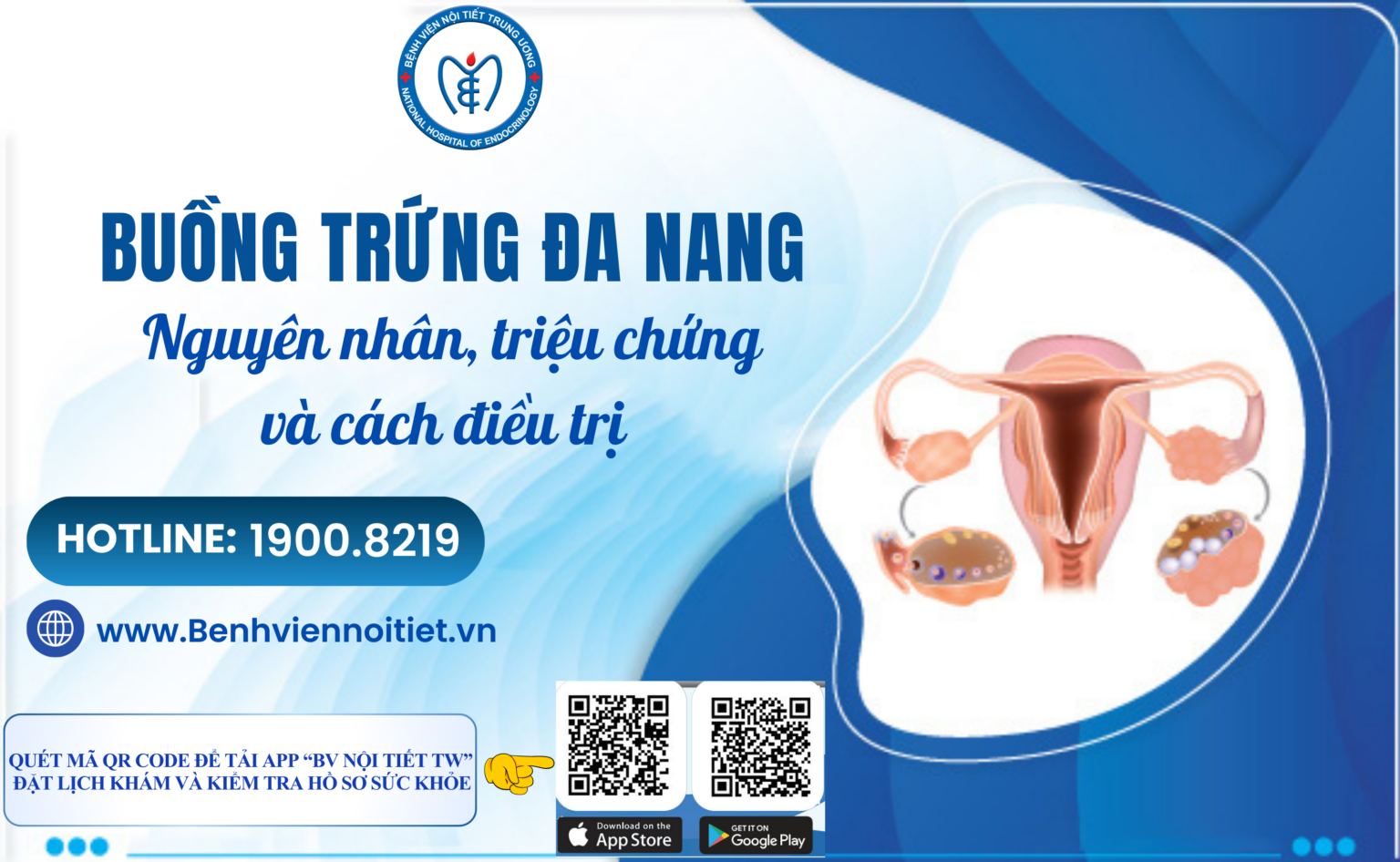 Hội chứng buồng trứng đa nang (pcos): Nguyên nhân, triệu chứng và cách điều trị
