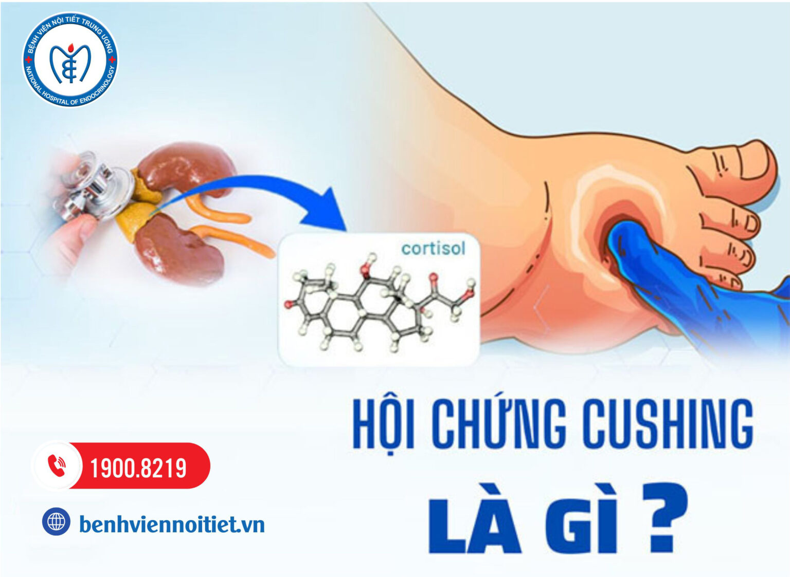 Hội chứng cushing: Nguyên nhân, triệu chứng và cách chữa trị