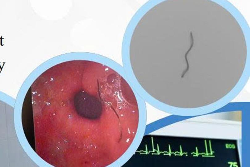 Gắp thành công sợi thép xuyên thành dạ dày bệnh nhân