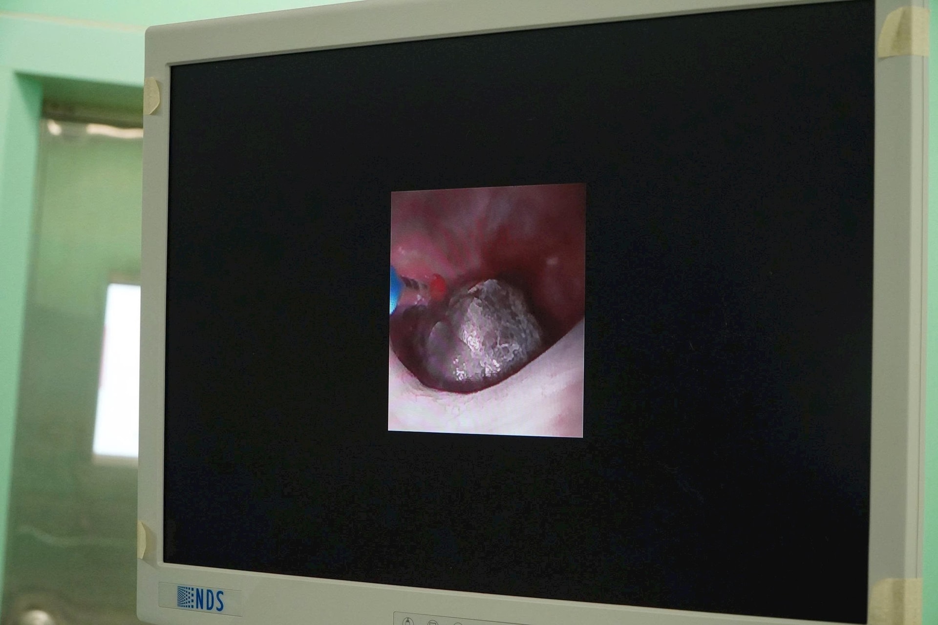 Bệnh viện Đa khoa Vũng Tàu triển khai thành công kỹ thuật tán sỏi niệu quản bằng laser