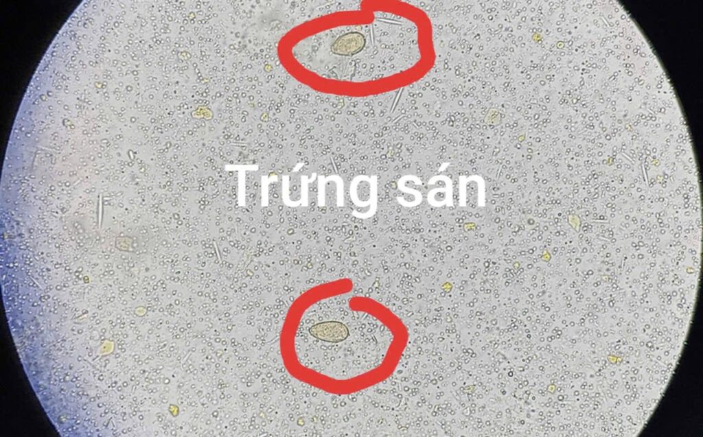 SÁN LÁ GAN NHỎ GÂY TẮC MẬT Ở BỆNH NHÂN VIÊM GAN DO RƯỢU: CẢNH BÁO THÓI QUEN ĂN ĐỒ TÁI SỐNG