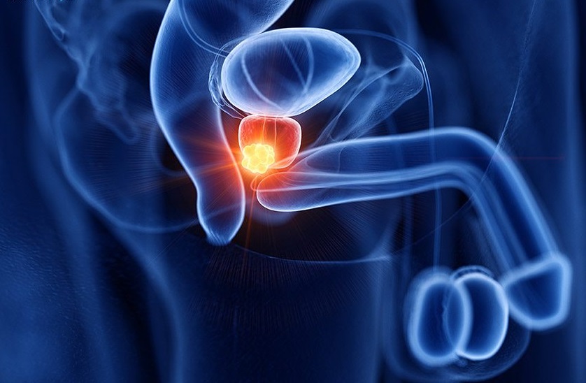 Liệu pháp phóng xạ nhắm trúng đích kết hợp nội tiết mở ra hướng điều trị mới cho ung thư tuyến tiền liệt di căn