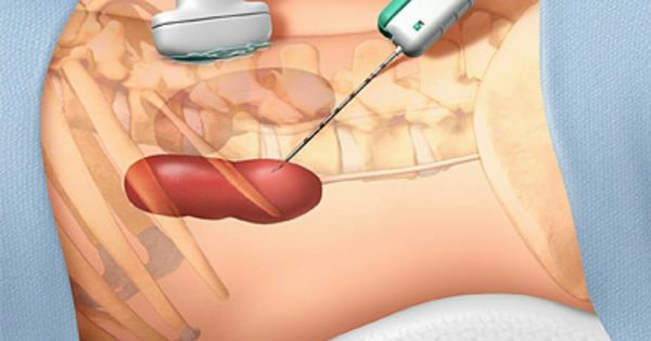 Sinh thiết thận: Những câu hỏi thường gặp