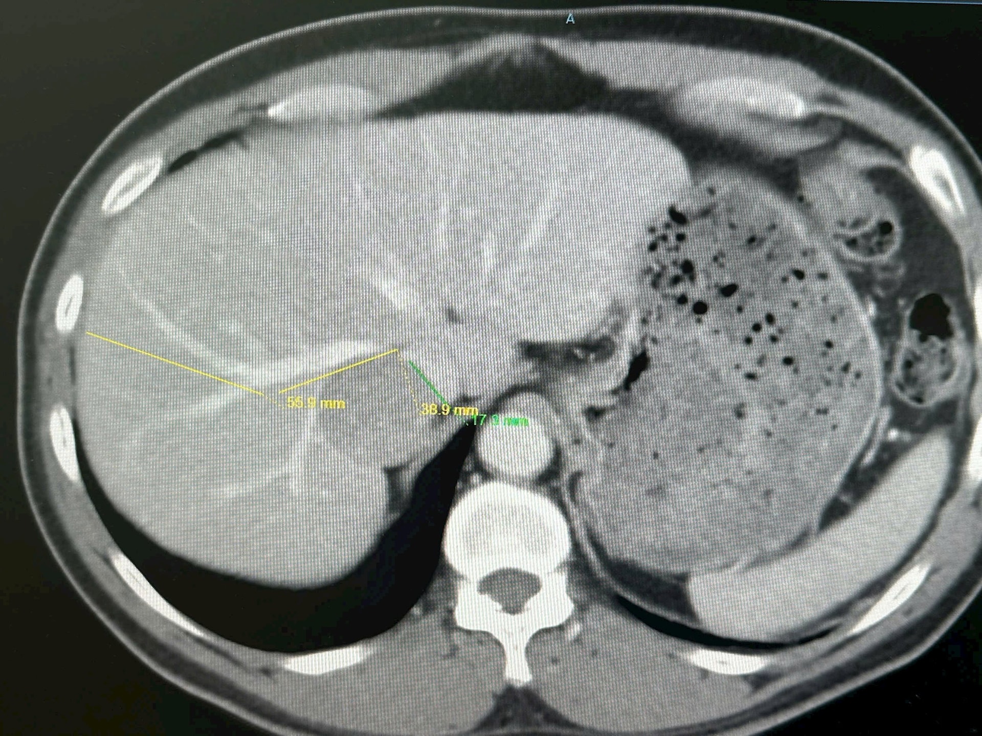 Ca mổ dài 2,5 giờ cắt khối u gan nằm sát tĩnh mạch chủ dưới