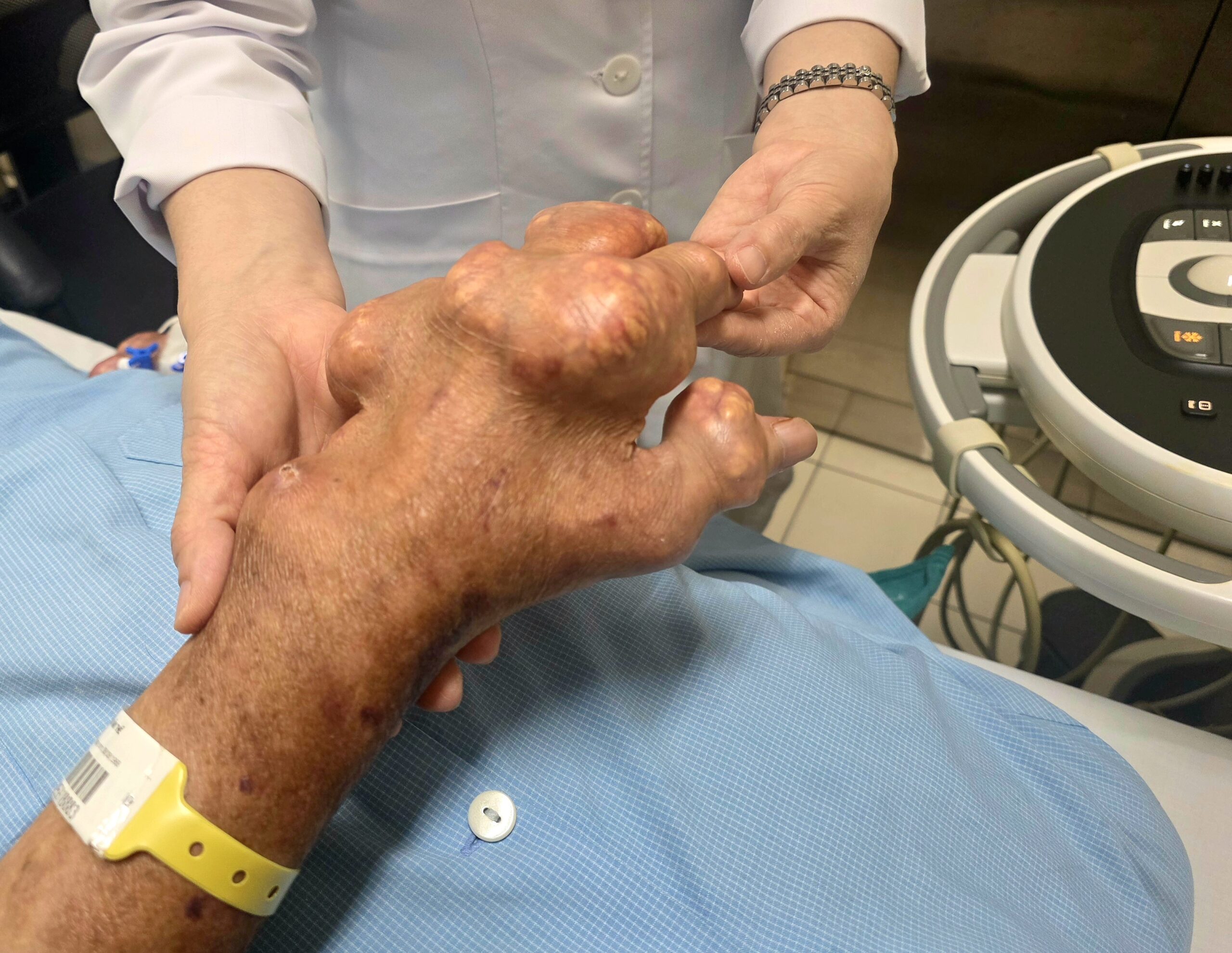 Gút – Đừng để “cơn đau trong đêm” trở thành nỗi ám ảnh suốt đời