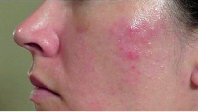 “Viêm da tiết bã” và những điều cần biết