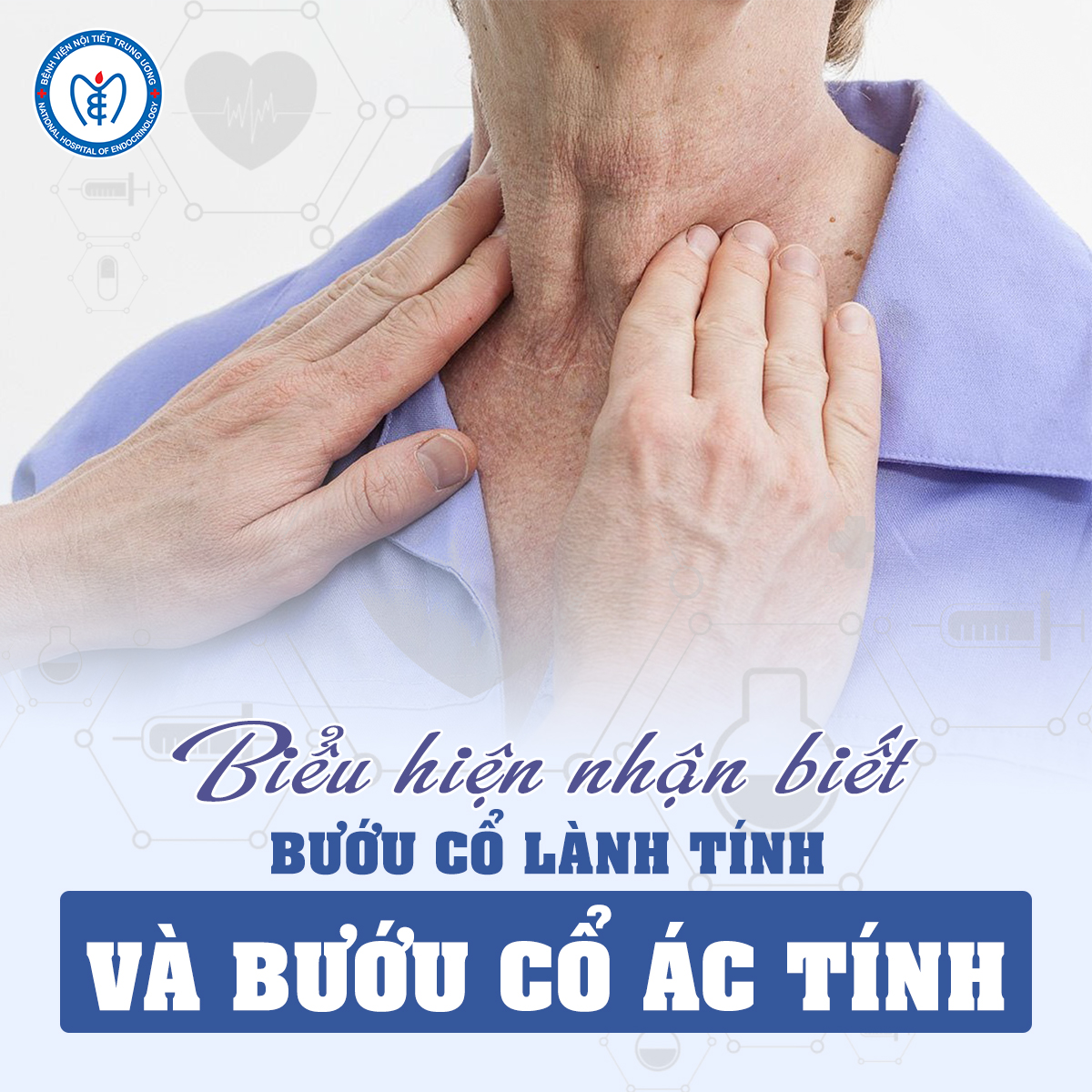 Biểu hiện của bướu cổ lành tính và bướu cổ ác tính
