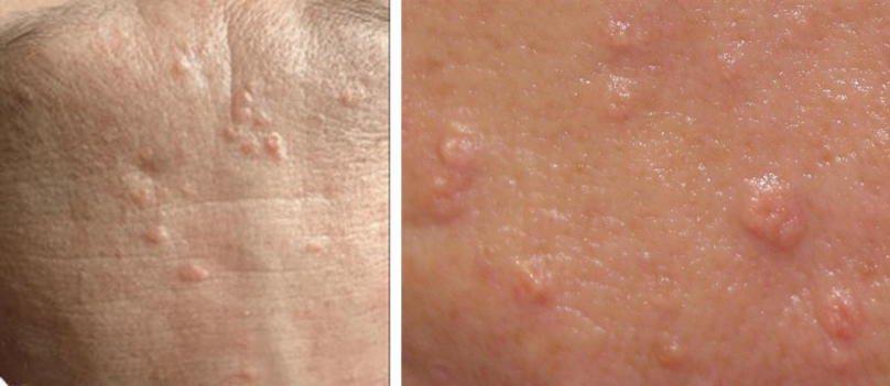 Quá sản tuyến bã  (Sebaceous hyperplasia)