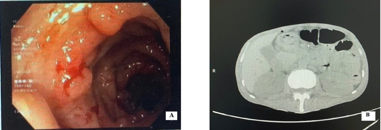 BỆNH VIÊM LOÉT ĐẠI TRÀNG