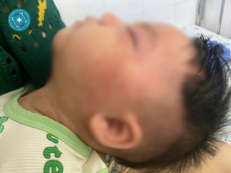 Nhận biết sởi ở trẻ em từ sớm: Những điều cha mẹ nhất định phải biết