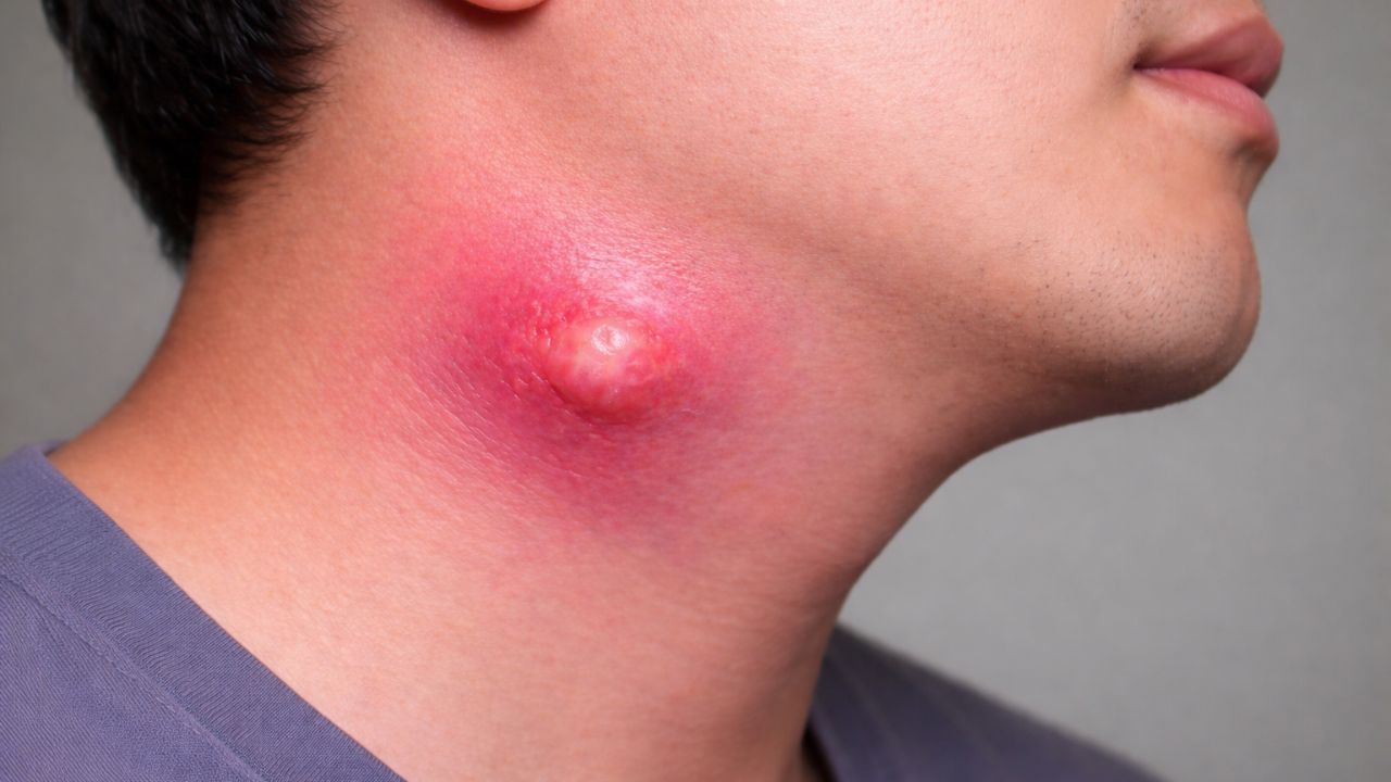 Áp xe cổ – Bệnh nguy hiểm có thể đe dọa tính mạng nếu phát hiện muộn