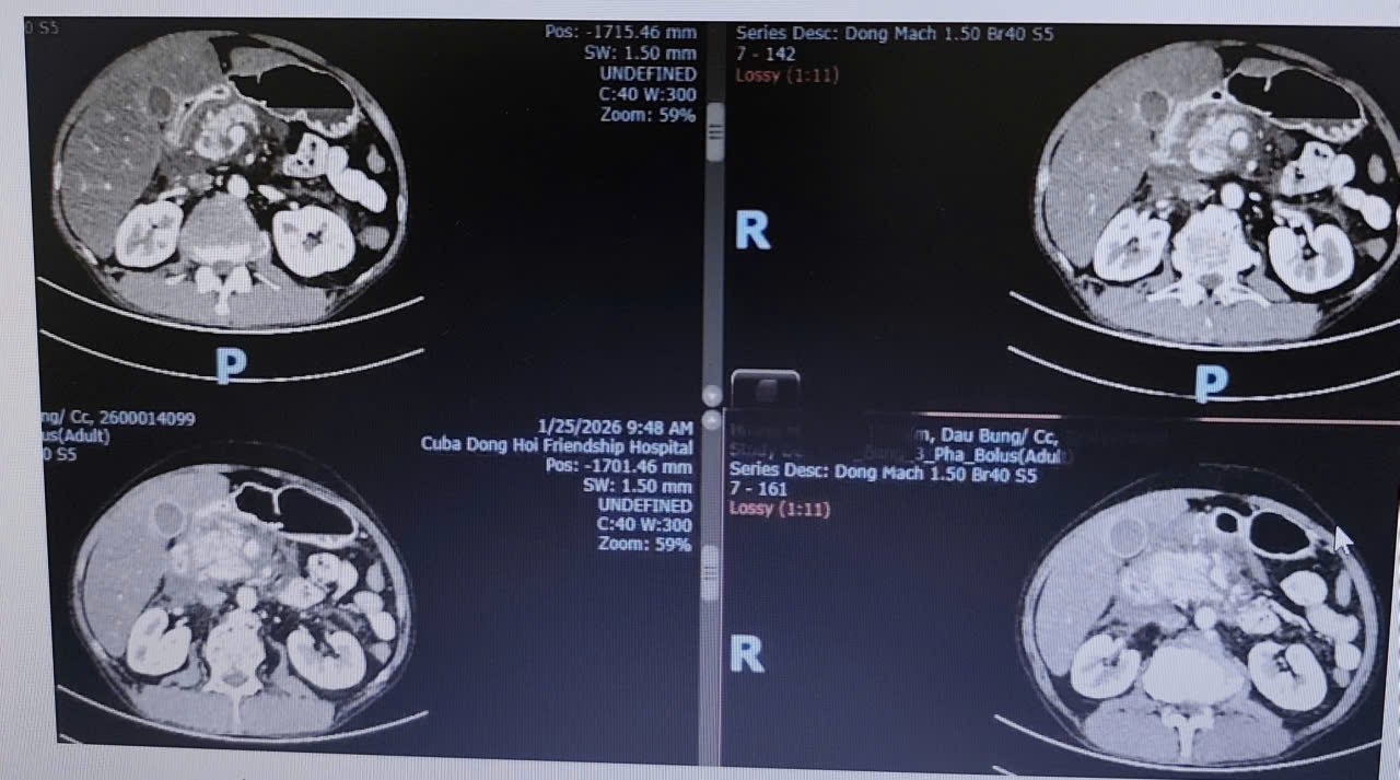 Kỳ tích hồi sức: Cuộc chiến 192 giờ cứu sống bệnh nhân có máu “đục như sữa” và suy đa tạng kịch phát.