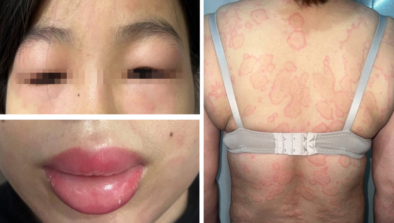 Mày đay mạn tính kèm phù mạch nặng: Nhận biết các triệu chứng cần điều trị cấp cứu
