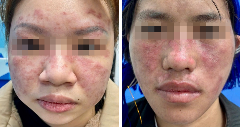 Tổng quan tổn thương da trong bệnh Lupus ban đỏ