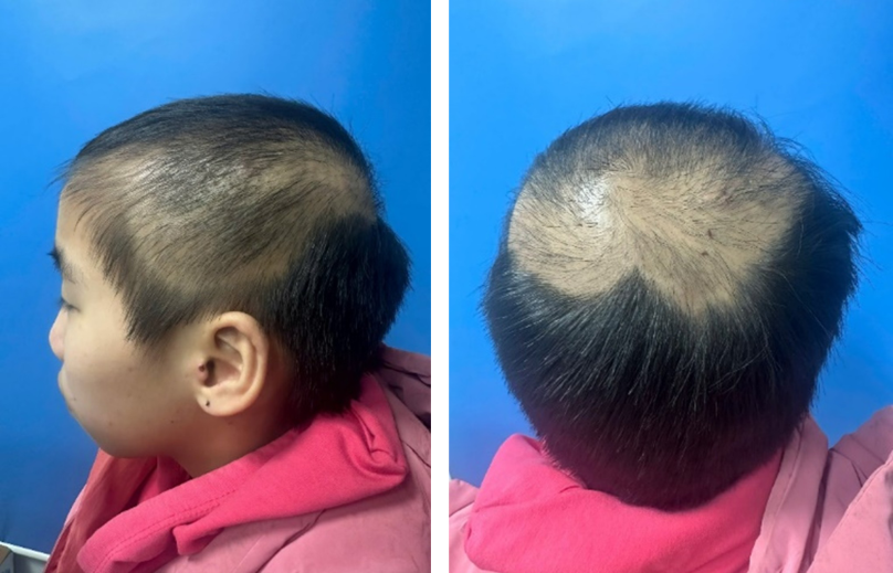 Tật nhổ tóc (Trichotillomania): Hiểu rõ để chẩn đoán và điều trị kịp thời