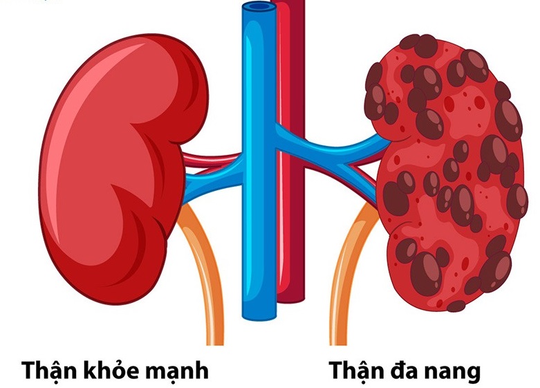 Thận đa nang – Đừng để di truyền trở thành “án phạt” cho sức khoẻ
