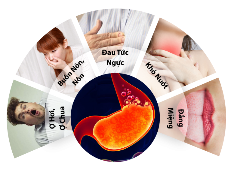 Trào ngược dạ dày thực quản – Những điều cần biết và điều chỉnh cải thiện bệnh